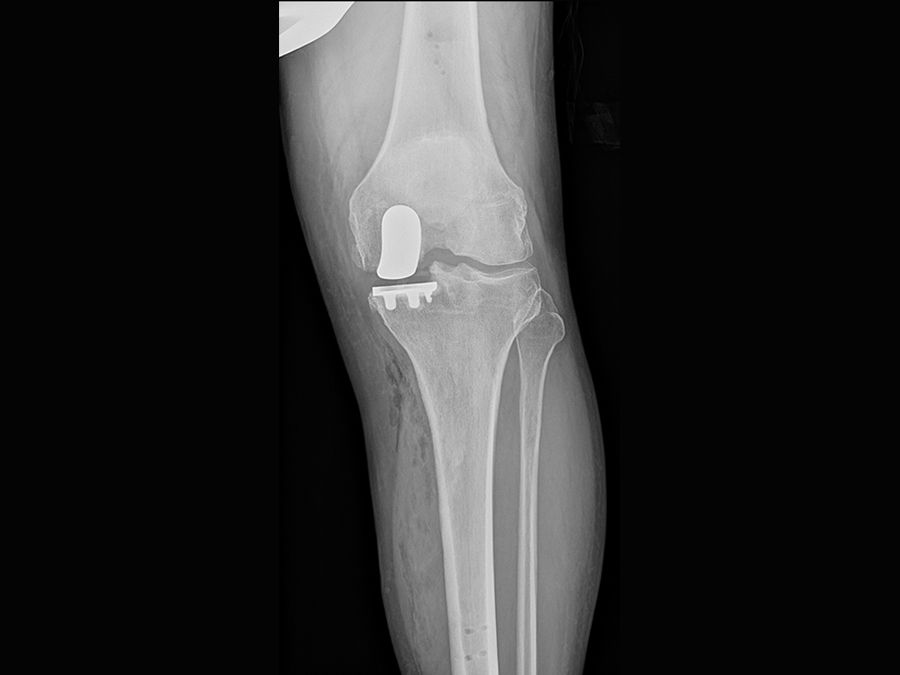 partial-knee-replacement